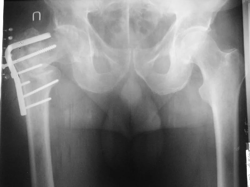 Трещина тазобедренного. Чрезвертельный перелом шейки бедра рентген. Чрезвертельный перелом бедренной кости со смещением рентген. Чрезвертельный перелом бедренной кости рентген. Перелом бедренной кости со смещением рентген.