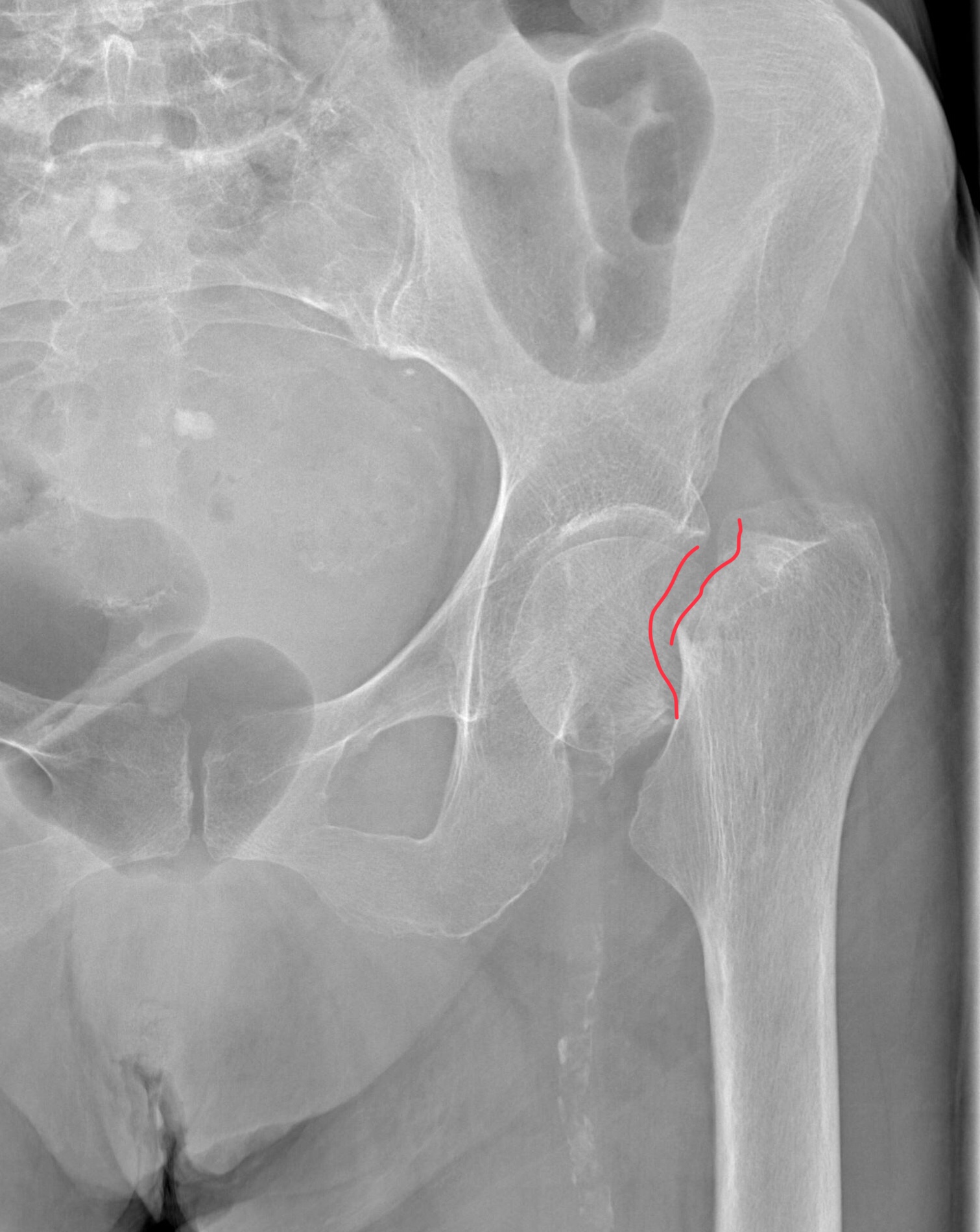 Сломана шейка бедра операция. Вколоченный перелом шейки бедра рентген. Перелом шейки бедра рентгенограмма. Перелом шейки бедренной кости рентген. Рентген тазобедренного сустава перелом шейки бедра.