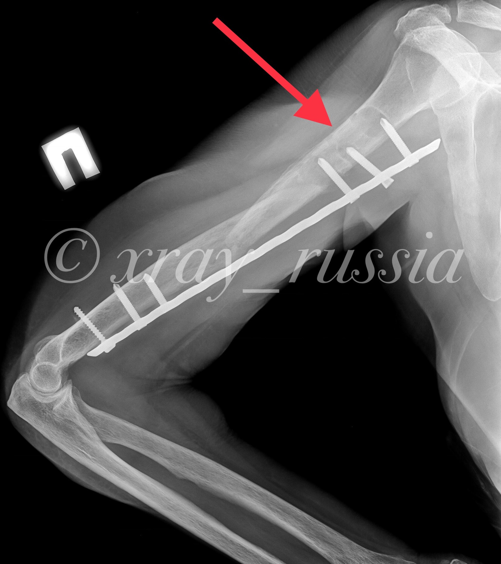 Рентгеновские пластины. Остеосинтез перелома плечевой кости. Остеосинтез плечевой кости пластиной. Пластина титановая для плечевой кости.