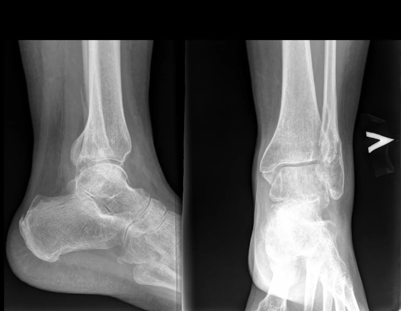 Трещина кости на ноге. Супинационный перелом лодыжки рентген. Вывих малоберцовой кости рентген. Перелом лодыжки внешней кости. Трехлодыжечный перелом рентген.