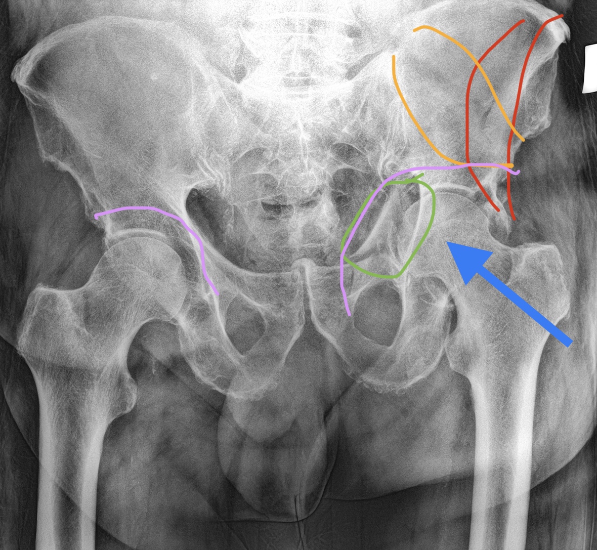 Оперативный разрыв. Перелом костей таза рентгенограмма. Подвздошная кость рентген анатомия. Перелом тазовой кости рентген. Вертлужная впадина тазовой кости рентген.
